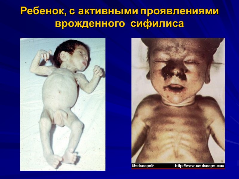 Ребенок, с активными проявлениями врожденного  сифилиса